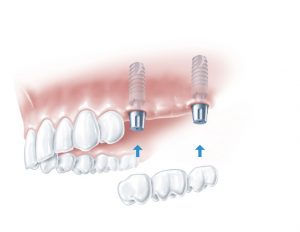 1221350-Implant borne bridge-GPM